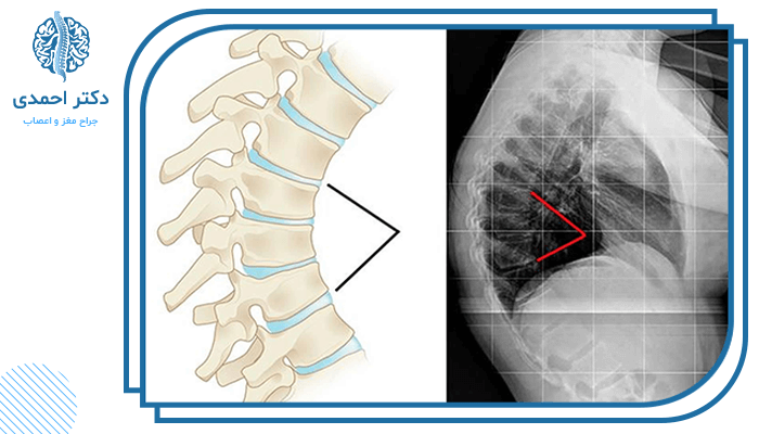 گوژپشتی یا کیفوز چیست؟