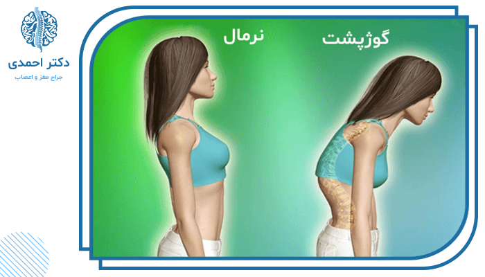 دلایل جراحی اصلاح کیفوز