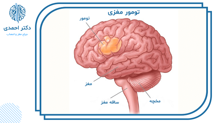 تومور مغزی