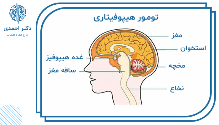 درمان تومور مغزی به چه عواملی بستگی دارد ؟