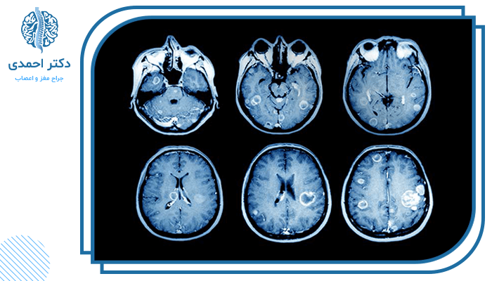 روش‌های تشخیص تومور مغزی