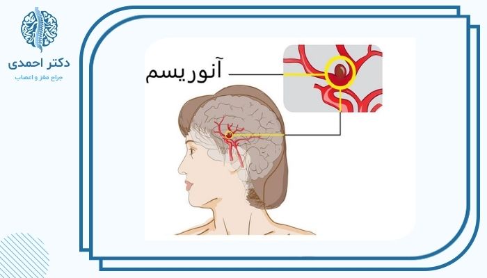 آنوریسم مغزی چیست؟