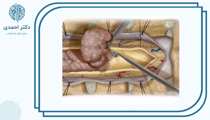 علل تومورهای اولیه و متاستاتیک در ستون فقرات 