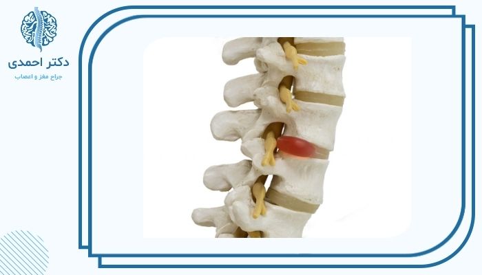 راه‌های تشخیص دیسک کمر