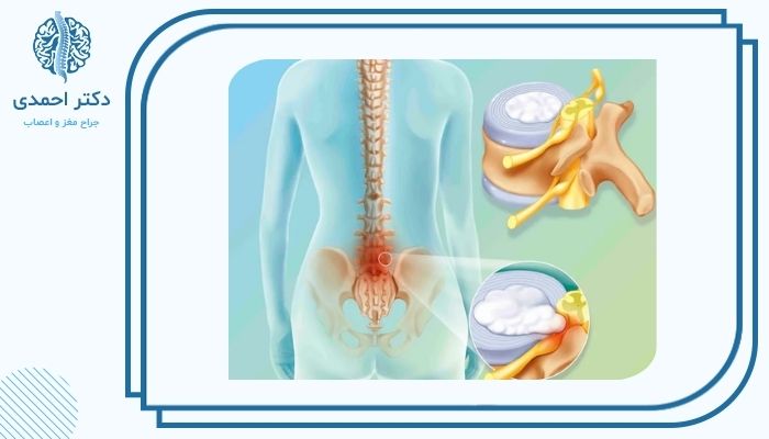 راهکارهای جلوگیری از بدتر شدن وضعیت کمر