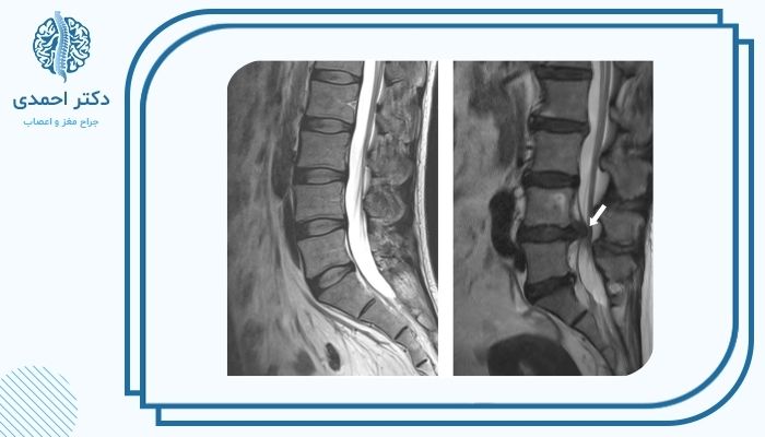 روش‌های تشخیص بیرون زدگی دیسک کمر