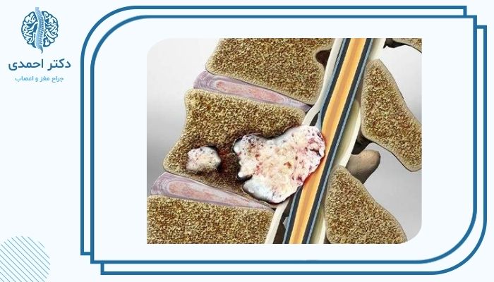 علائم توده‌های نخاعی 