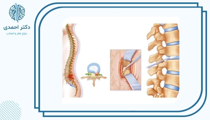 چگونه از عوارض جراحی دیسک کمر جلوگیری کنیم؟