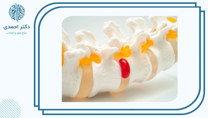 دلایل انجام عمل دیسک کمر