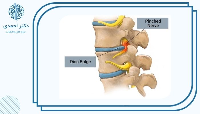 دلایل به وجود آمدن دیسک و آرتروز گردن