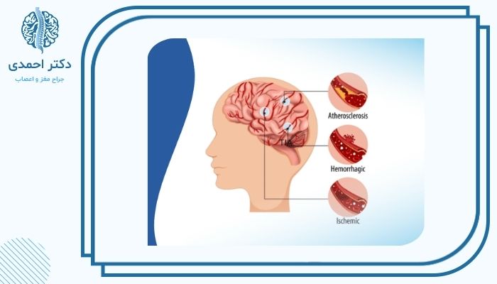 تفاوت درمان حمله عصبی و سکته مغزی چیست؟ تفاوت درمان حمله عصبی و سکته مغزی چیست؟