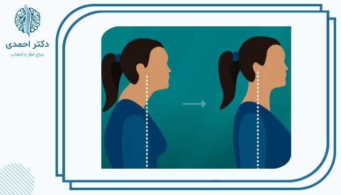 علت خم شدن گردن به جلو و روش درمان علت خم شدن گردن به جلو و روش درمان