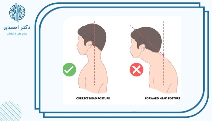 آیا قوز گردن خطرناک است؟ آیا قوز گردن خطرناک است؟