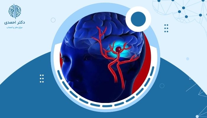 آنوریسم مغزی چیست و چرا خطرناک است؟ بررسی علل و درمان ها
