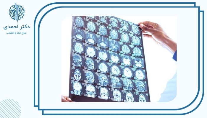 روش‌های تشخیص آنوریسم