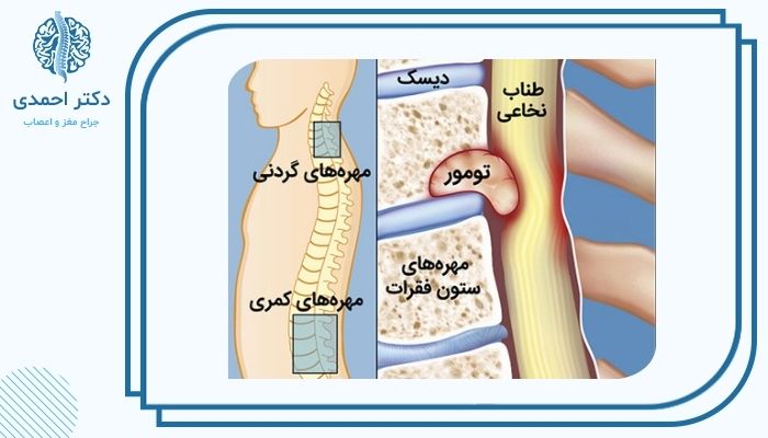 آیا تومور ستون فقرات می‌تواند باعث فلج شود؟