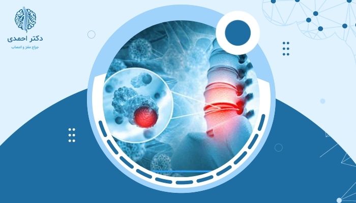آیا تومورهای ستون فقرات باعث فلج می‌شوند؟ آنچه باید بدانید