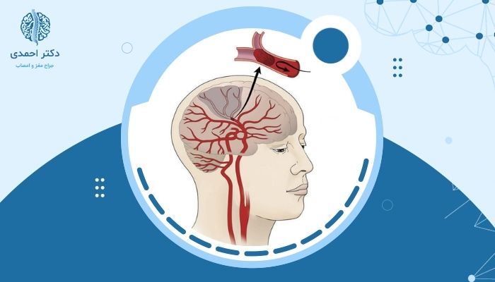 آیا سکته مغزی باعث مرگ می‌شود و چقدر خطرناک است؟