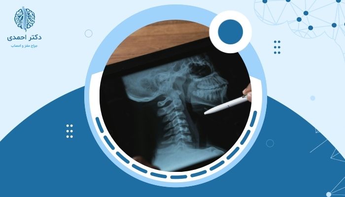 آیا عمل دیسک گردن خطرناک است؟ بررسی عوارض احتمالی