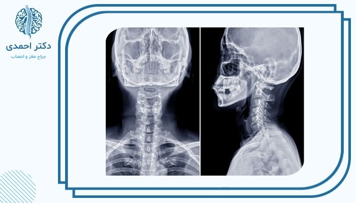 عمل دیسک گردن در چه شرایطی توصیه می شود؟ عمل دیسک گردن در چه شرایطی توصیه می شود؟