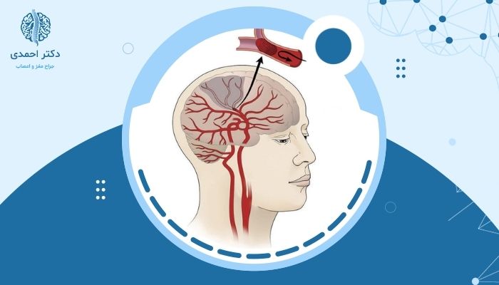 بعد از سکته مغزی چه اتفاقی می‌افتد؟ بررسی کامل علائم و عوارض