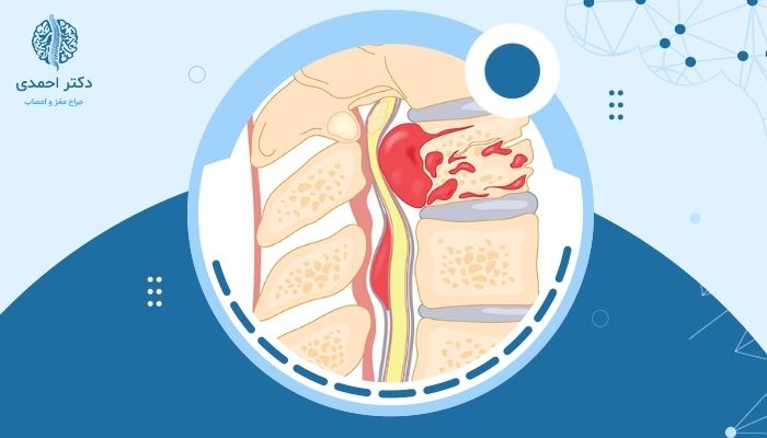 تفاوت بین تومورهای اولیه و متاستاتیک در ستون فقرات