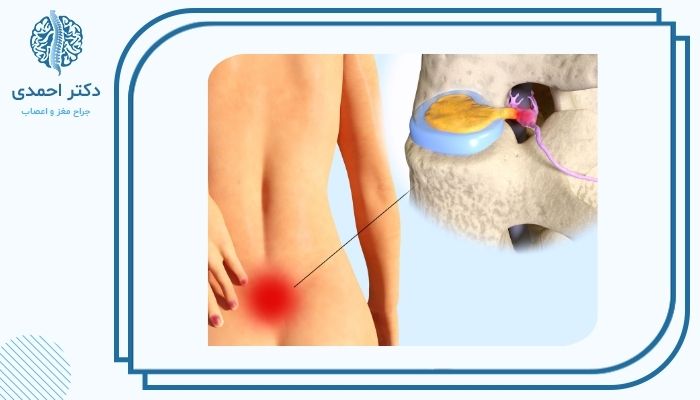 تفاوت اصلی بین تنگی کانال نخاعی و فتق دیسک تفاوت اصلی بین تنگی کانال نخاعی و فتق دیسک