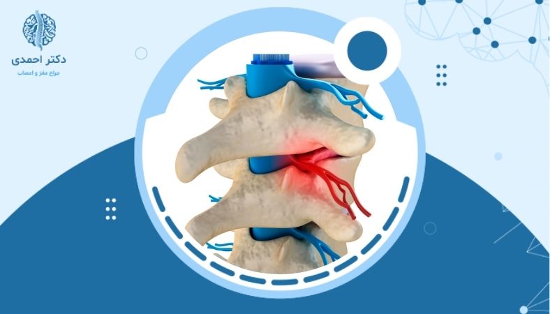 دلایل اصلی تنگی کانال نخاعی چیست و چه افرادی در معرض خطرند؟