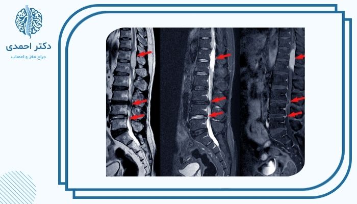 اصلی ترین دلایل تنگی کانال نخاعی اصلی ترین دلایل تنگی کانال نخاعی