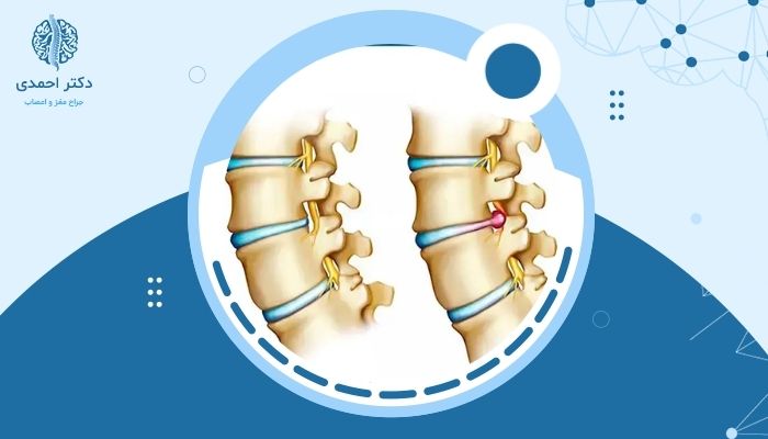 چگونه می‌توان از بازگشت دیسک کمر بعد از عمل جلوگیری کرد؟